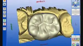 San Diego Dentist Performs 1-visit CEREC Dentistry