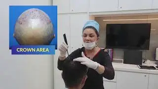 7 BULAN SELEPAS TANAM RAMBUT FUE | Iplus Hair Transplant Expert
