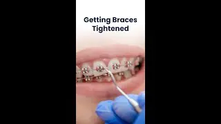 Whats the process of getting your braces tightened?