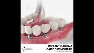 Implantologia a carico immediato - Denti fissi in poche ore #viral #subscribe #mrbeast