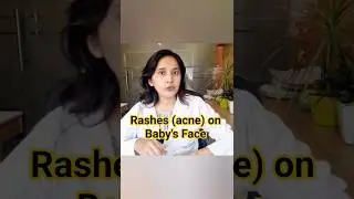 Rashes on baby's face, Neonatal acne. #shorts #shortsvideo #youtubeshorts