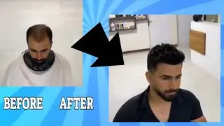 SOLUZIONE PERDITA CAPELLI E CALVIZIE : protesi capelli/ HAIR REPLACEMENT SYSTEM/ protesis capilar