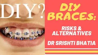 DIY BRACES (DO IT YOURSELF BRACES): RISKS & ALTERNATIVES - DR SRISHTI BHATIA