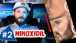Bart Entwicklung mit Minoxidil | Bartwuchs Info Check Folge2