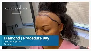 Traction Alopecia Hairline Restoration With Widow&rsquo;s Peak Preservation | Dr. Blumenthal (Diamond)