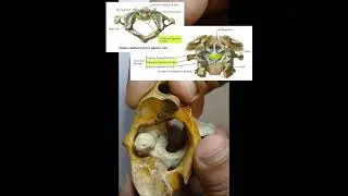 Atlas Vertebra (C1) Osteology | Cervical Spine Anatomy for MBBS/BDS/NEET PG