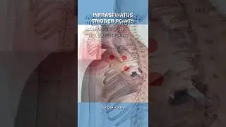 Вызывают ли триггерные точки подостной мышцы боль в плече?