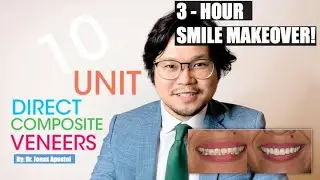 Instant Hollywood Smile Philippines | Direct Composite Veneers | Makati Cosmetic Dentist