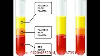 Kan Se Sunai Na Dene Ka Natural Plasma Therapy Se Treatment