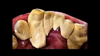 Can You Watch Till the End? Top 3 Most Impressive Tartar Removals!#1