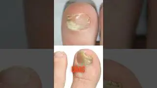 As&iacute; debes tratar los hongos en las u&ntilde;as de los pies 🦶 #onicomicosis #u&ntilde;as  #hongo #tratamiento