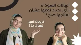 حددي نوع الهالات السودا عشان تعرفي تعالجيها صح ، هل كريمات العين فعلا بتعالج ؟