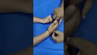 After fracture operated of physiotherapy#joints #pain #stiffness #movement #physiotherapy #finger