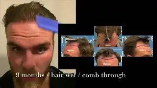 LUKE's FUE HAIR TRANSPLANT JOURNEY