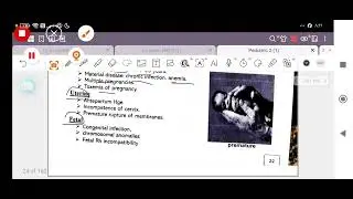 Newborn part 4:  kernicterus and prematurity (MEDECIN &Pediatric 2) 42