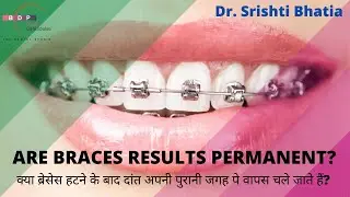 Are braces results permanent? क्या ब्रेसेस हटने के बाद दांत अपनी पुरानी जगह चले जाते हैं? Dr.Srishti