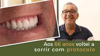 Aos 66 Anos Voltei a Sorrir Com Protocolo - Implace Implantes