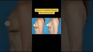 Before & After - Direct to Implant Breast Reconstruction