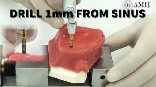 Sinus Bump Protocol