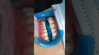 Dentist Cleaning Teeth  // Dental Cavity Filling // Dentist  // Dental Braces ..