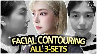 [Plastic surgery in Korea] Mandible Jaw Reduction + Cheekbone Reduction + Genioplasty #koreabeauty