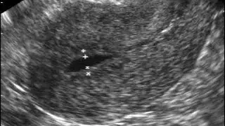 Vaginal Bleeding.