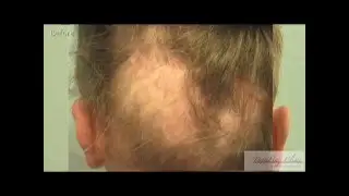 Worst Hair Transplant Result - Repair Using FUE & BHT, with Beard & Body Hair - Dr Umar part 2 of 3