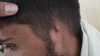 कान ही नहीं है / Anotia 