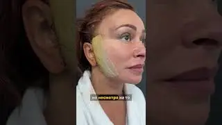 Первые сутки после Deep Plane Facelift 📲+7(985)002-10-50