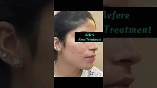Best acne treatment in Punjab|Acne specialist in Punjab #drashimagoel #skincare # #parisaskinclinic