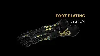 OSTEONIC SIGNEX FOOT PLATING SYSTEM