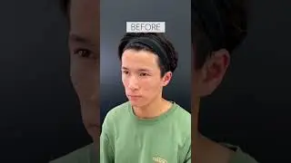 【頬コケ改善】脂肪注入で自然に若返る！　#shorts #脂肪注入 #美容整形