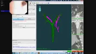 Automated airway registration using CustusX and Anser EMT