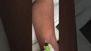 Stretch Marks Inkless Removal Boleyn Treatment Los Angeles #shorts #stretchmarks #stretchmarkremoval