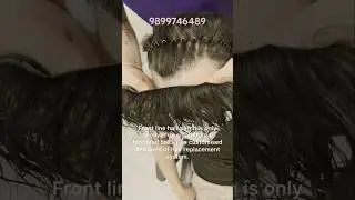 natural frontline hair patch. frontline hair patch price. frontline hair patch for men ￼￼