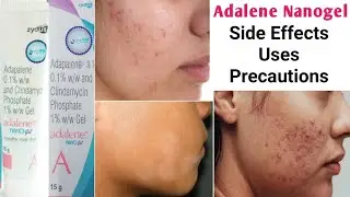 Adalene nanogel gel uses in hindi । Side Effect | Precaution | Midicine Hub #Adapalene #Clindamycin