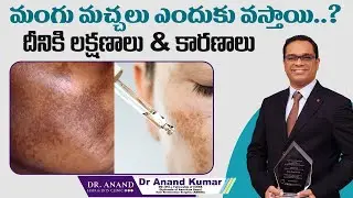 మంగు మచ్చలు ఎందుకు వస్తాయి..? | Laser Treatment For Melasma | Dr Anand Hair And Skin