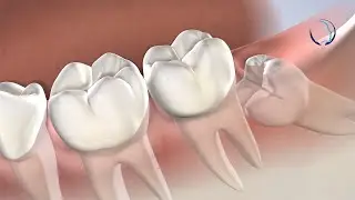 Wisdom Teeth Removal in Groton, MA