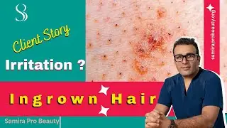 Does Laser Hair Removal Help with Ingrown Hairs? | Mary&rsquo;s Story