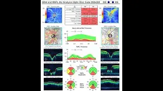OCT in Glaucoma