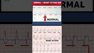 हार्ट अटैक का ECG - HEART ATTACK ECG VS NORMAL ECG#shorts