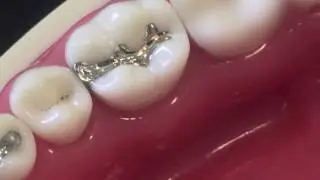 class II amalgam cavity preparation and restoration