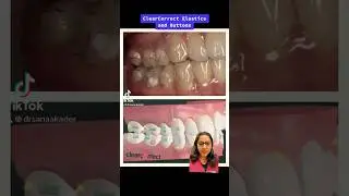 ClearCorrect aligners elastics and buttons. #clearcorrect #clearaligners #indigodental #dentist