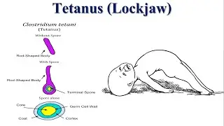 Tetanus: The Deadly Consequences of Neglected Wound Infections | Lockjaw | Tetanospasmin