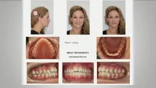 AcceleDent Aligner Series Featuring Dr. Jennifer Smith