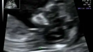 Tomsu-Sonogram2.mp4