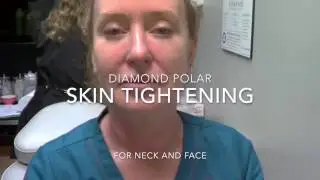 Diamond Polar Skin Tightening-Dr. Gidon Frame