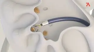 Alleima nitinol retrieval basket &ndash; Open-ended