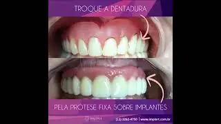 TROQUE A DENTADURA POR UMA PROTESE FIXA SOBRE IMPLANTES - PR&Oacute;TESE PROTOCOLO