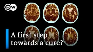 US drugmaker: Alzheimer's development can be slowed down | DW News
